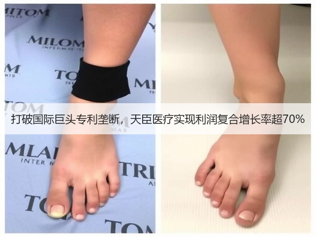 打破国际巨头专利垄断,天臣医疗实现利润复合增长率超70%(图1) 打破国际巨头专利垄断,天臣医疗实现利润复合增长率超70%(图1)
