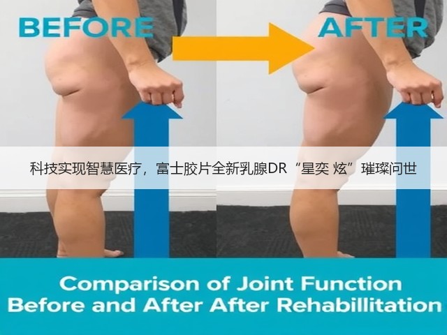 科技实现智慧医疗,富士胶片全新乳腺DR“星奕 炫”璀璨问世(图2) 科技实现智慧医疗,富士胶片全新乳腺DR“星奕 炫”璀璨问世(图2)