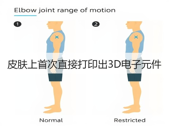 皮肤上首次直接打印出3D电子元件(图1) 皮肤上首次直接打印出3D电子元件(图1)
