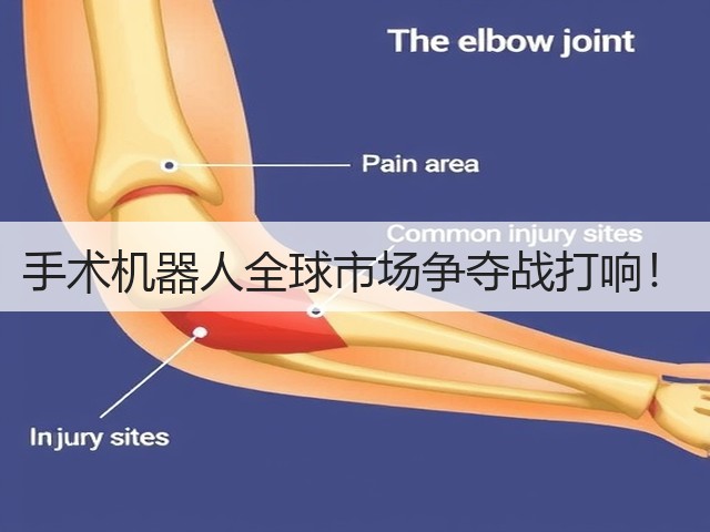 手术机器人全球市场争夺战打响!(图3) 手术机器人全球市场争夺战打响!(图3)